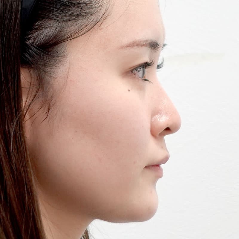 20250831_St20250831_tanaka_hyaluronic lips eye bags nose　②Before